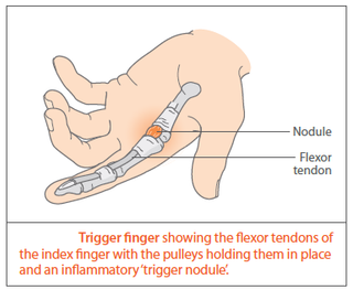 Stenosing tenosynovitis (finger flexor tendon) – GPnotebook - GPNotebook