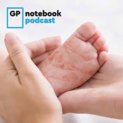 Adult hand holding a baby's foot showing symptoms of a rash, with GP Notebook Podcast logo in the corner.