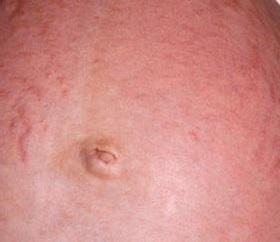 Close-up of a human skin with stretch marks and a belly button
