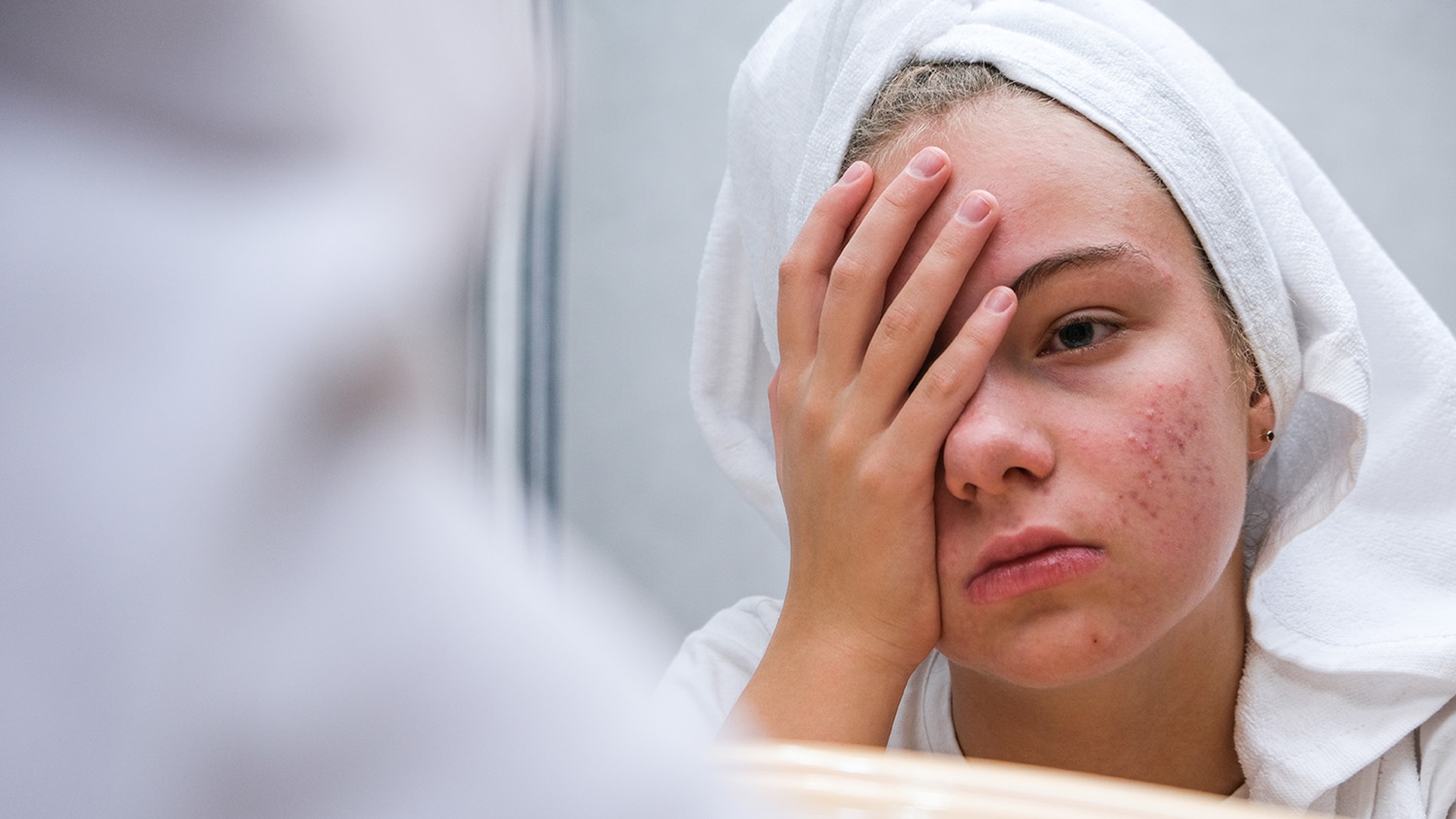 A young woman in a towel, with a hand over her face, looks distressed at her acne in a mirror.