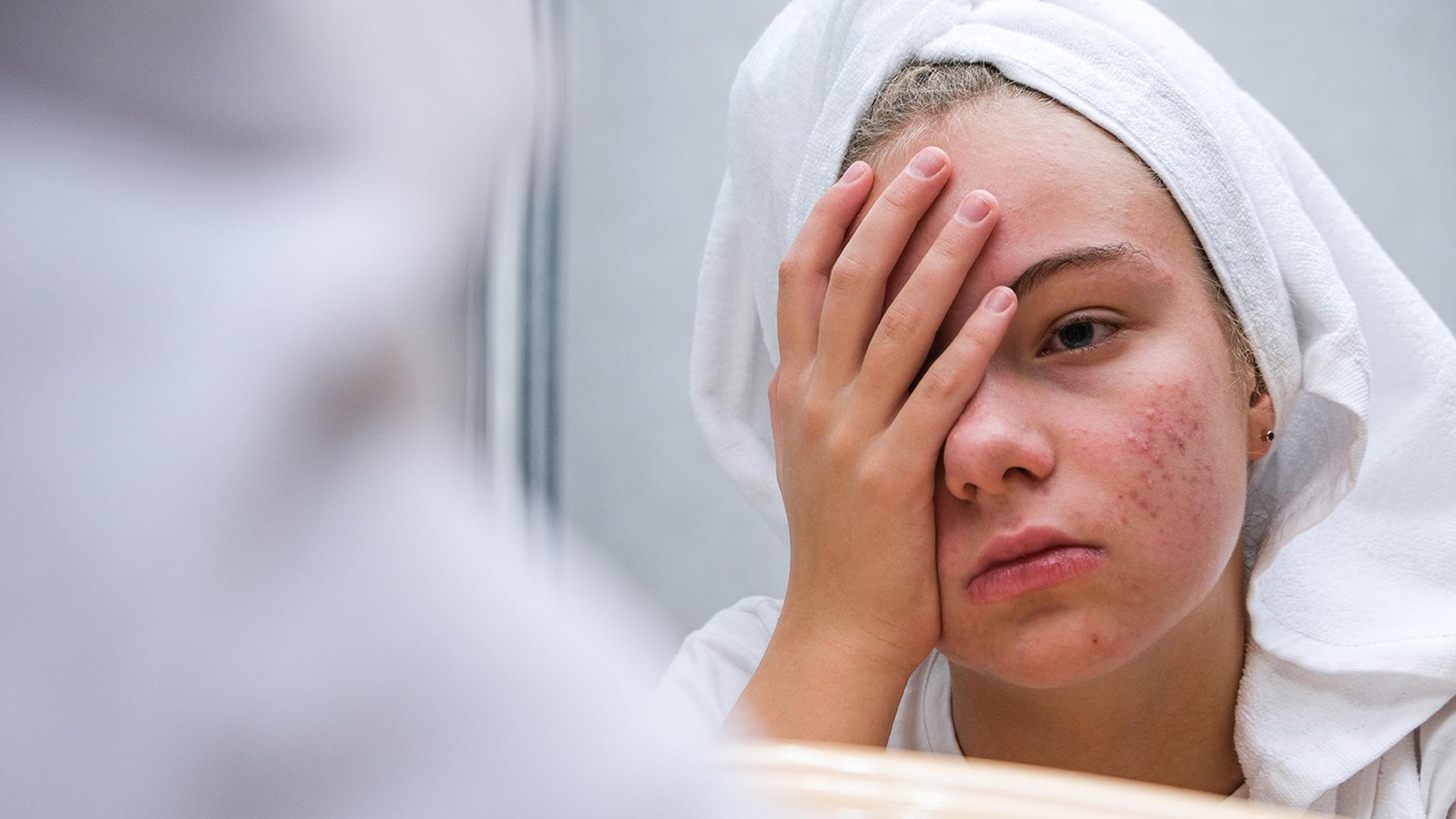 A young woman in a towel, with a hand over her face, looks distressed at her acne in a mirror.