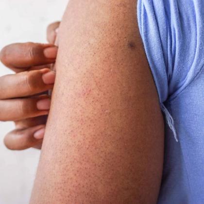 Dark-skinned arm with keratosis pilaris, gently held by a hand.