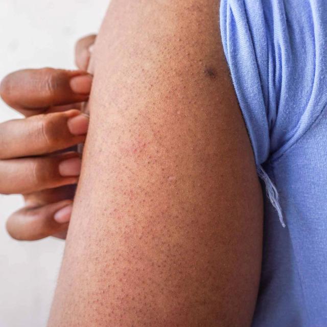 Dark-skinned arm with keratosis pilaris, gently held by a hand.