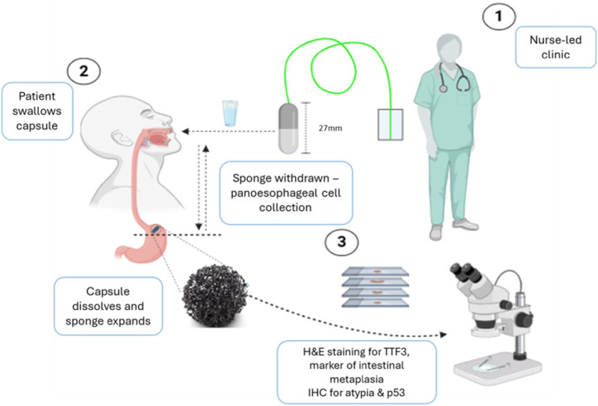 Flowchart of a nurse-led procedure for esophageal cell collection: a patient swallows a capsule that deploys a sponge to collect cells, which are then lab-analyzed for intestinal metaplasia, atypia, and p53.