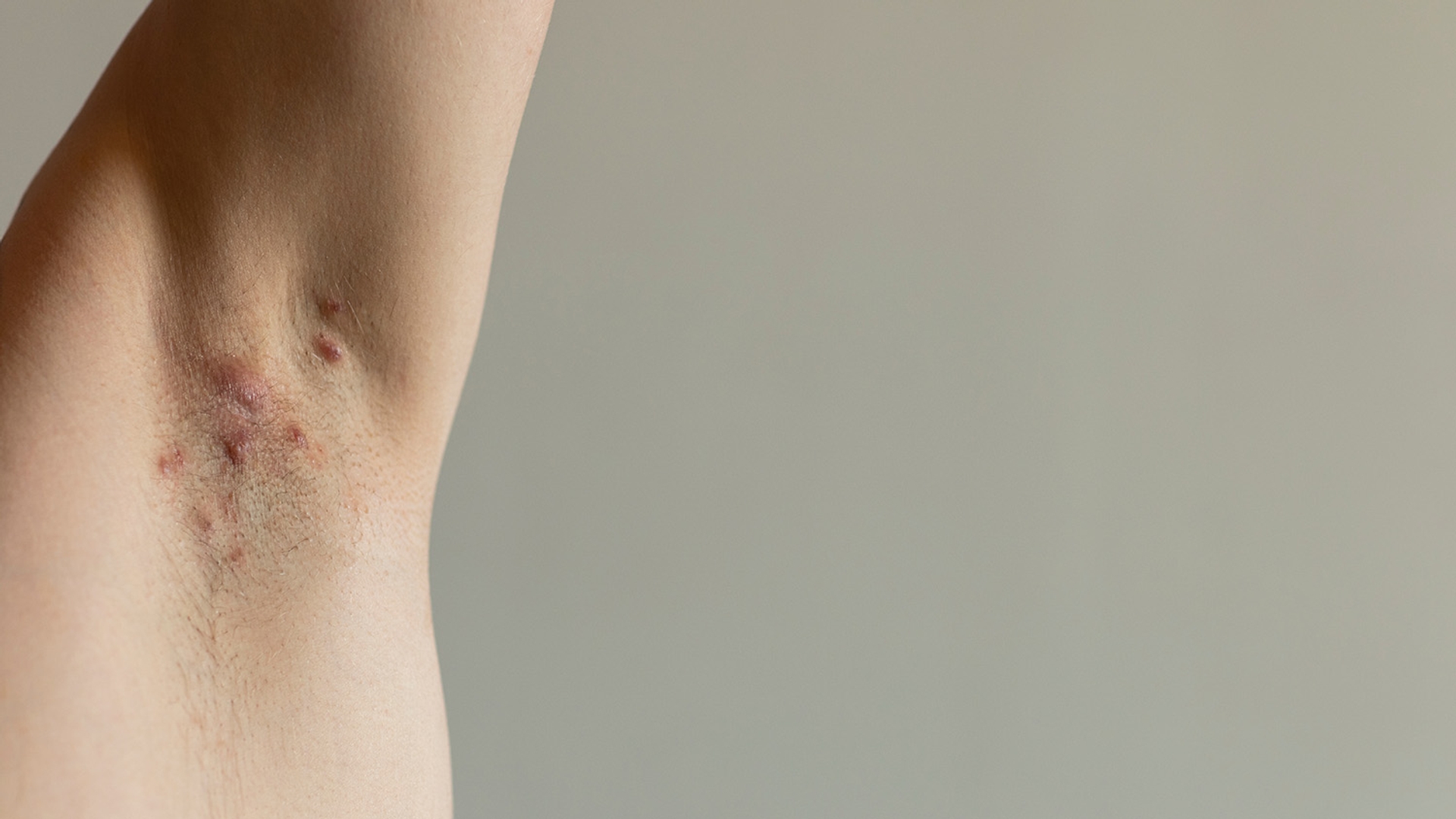 Close-up of an armpit with red, inflamed skin and bumps.