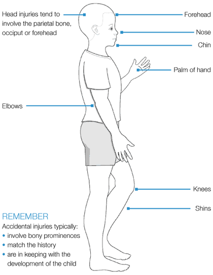 Non Incapacitating Injury Typical features of non-accidental injuries in children (injuries that ...