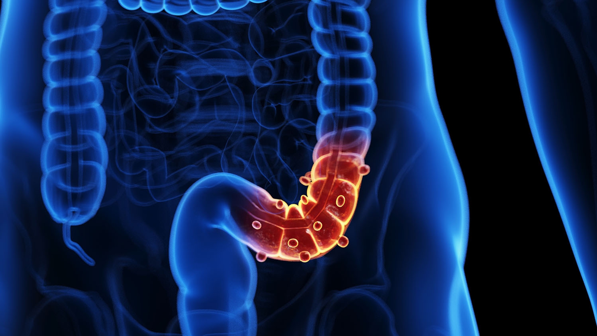 Medical illustration of a human colon with polyps.