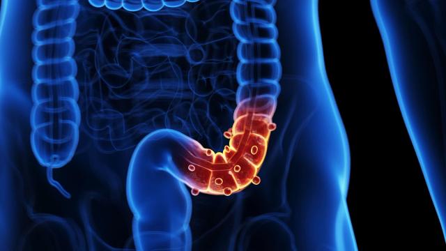 Medical illustration of a human colon with polyps.