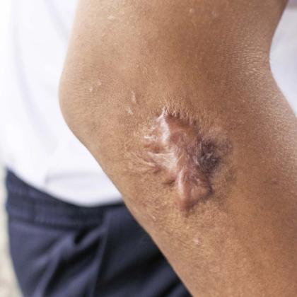Close-up of a healed scar on a person's elbow