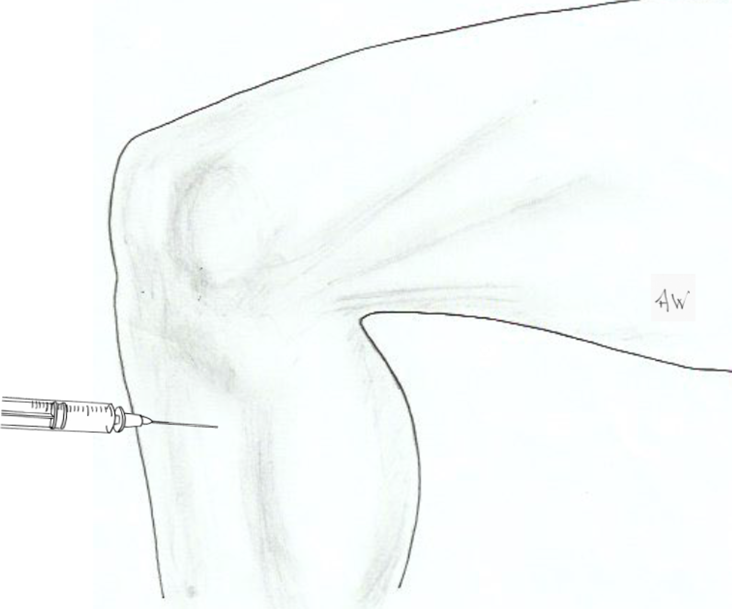Injection or aspiration of pes anserine bursa – GPnotebook - GPNotebook
