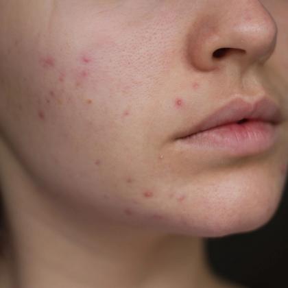 Close-up of a woman's lower face showing acne on her skin.