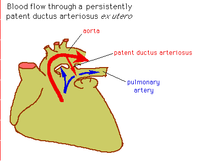 Diagram illustrating blood flow through a persistently patent ductus arteriosus in the heart, showing connections between the aorta and pulmonary artery.