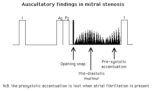 Graph showing auscultatory findings in mitral stenosis with labels for opening snap, mid-diastolic murmur, and pre-systolic accentuation, indicating sound wave patterns during heartbeats