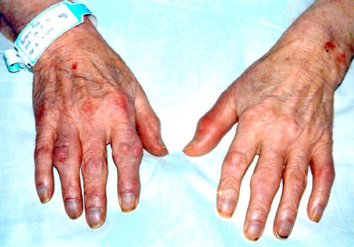 Elderly person's hands with visible signs of aging and minor injuries, resting on a hospital bed with a wristband visible
