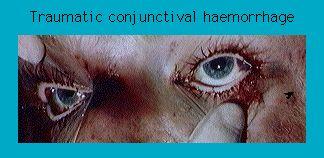 Close-up of an eye with traumatic conjunctival hemorrhage, showing redness and blood around the eye area with a hand pulling down the lower eyelid.