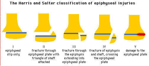 Illustration of the Harris and Salter classification of epiphyseal injuries, showing five types: I - epiphyseal slip only, II - fracture through epiphyseal plate with triangle of shaft attached, III - fracture through the epiphysis extending into epiphyseal plate, IV - fracture of epiphysis and shaft, crossing the epiphyseal plate, V - damage to the epiphyseal plate.