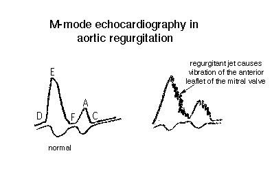aortic regurgitation echo