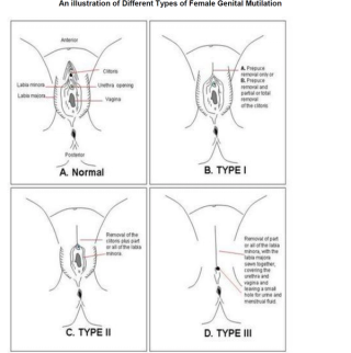 Infibulate Female genital reinfibulation – GPnotebook - GPNotebook