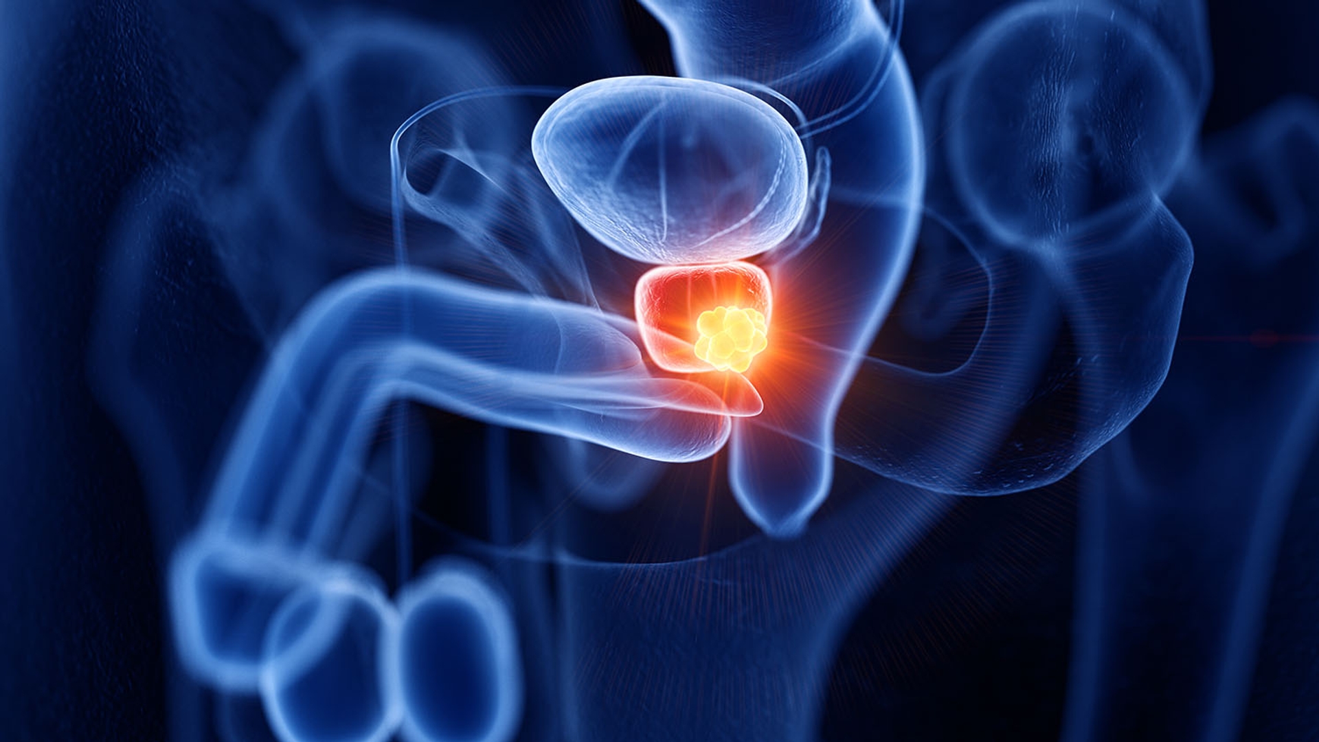 Medical illustration of prostate cancer.
