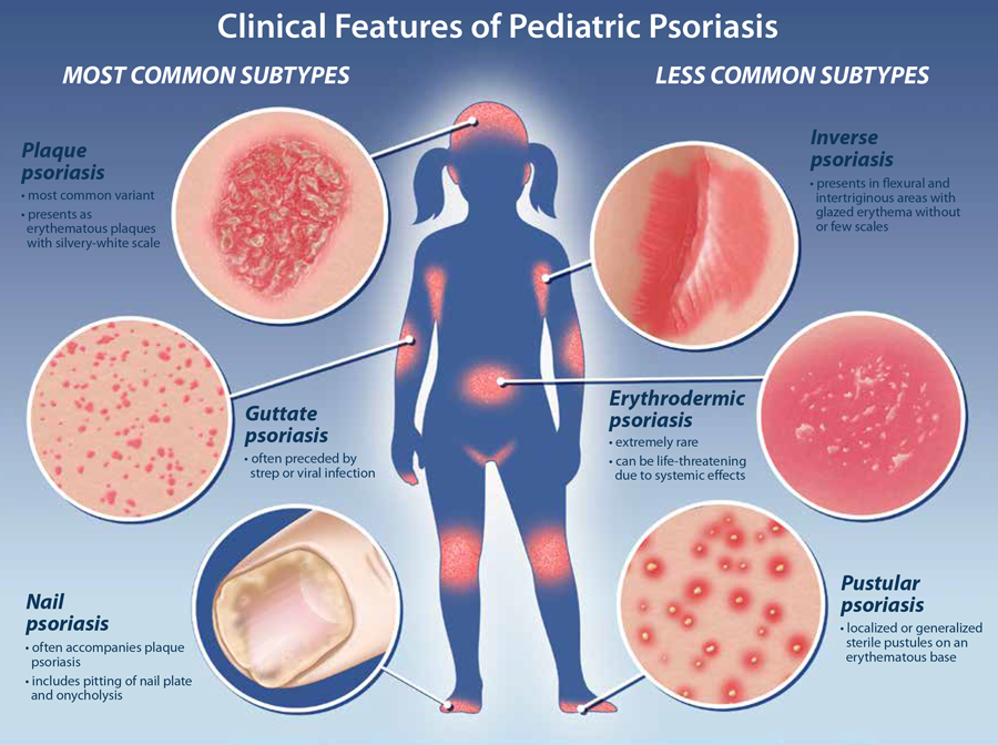 Pediatric Psoriasis