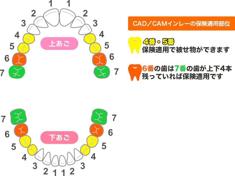 非金属冠の形成と接着　　　 　歯科衛生士　歯医者 685d6f536a2bfb74a876dc32689e6f