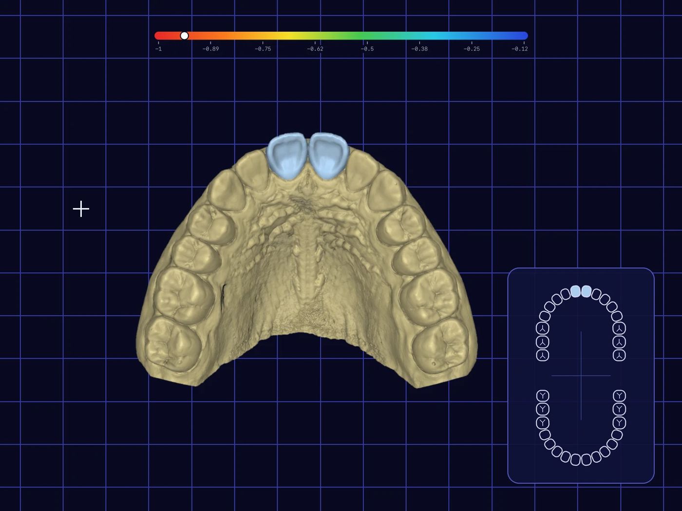A 3D scan of an upper dental arch with two new front crowns in light blue on a dark navy grid like dental design software, with a colour-scale bar at the top and a small odontogram showing the same two teeth selected