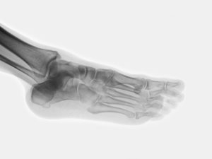 big toe joint arthritis