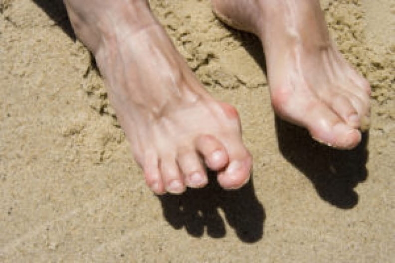 Hammer Toe Treatment in Beverly Hills
