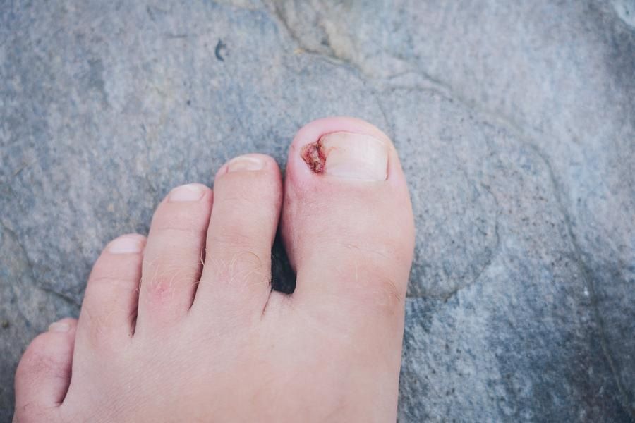 Foot with infected toenail on gray background. Patient needs foot doctor in Beverly Hills