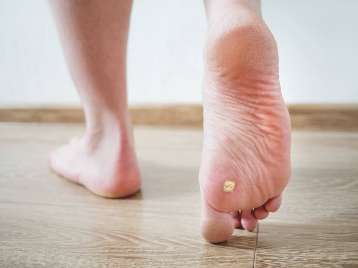 foot with wart