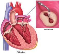 Percutaneous Mitral Valve Repair (MitraClip)