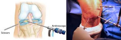 Knee Arthroscopy Surgery