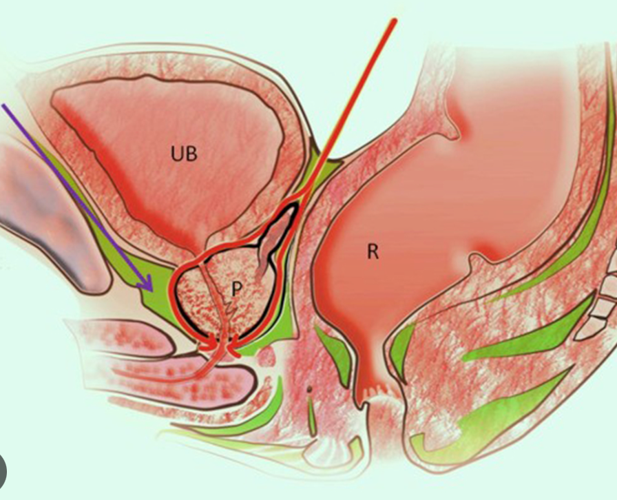 Radical Prostatectomy