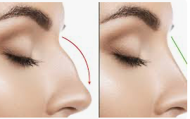 Rhinoplasty