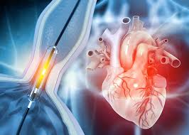 Coronary Angioplasty and Stenting