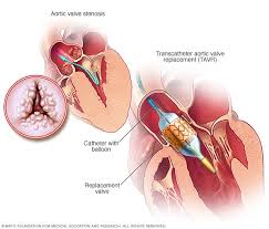 Transcatheter Aortic Valve Replacement (TAVR)