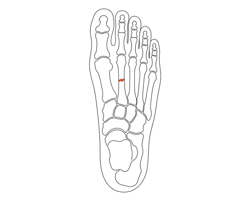 Foot anatomy illustration with the area affected by stress fractures highlighted