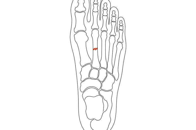 Foot anatomy illustration with the area affected by stress fractures highlighted
