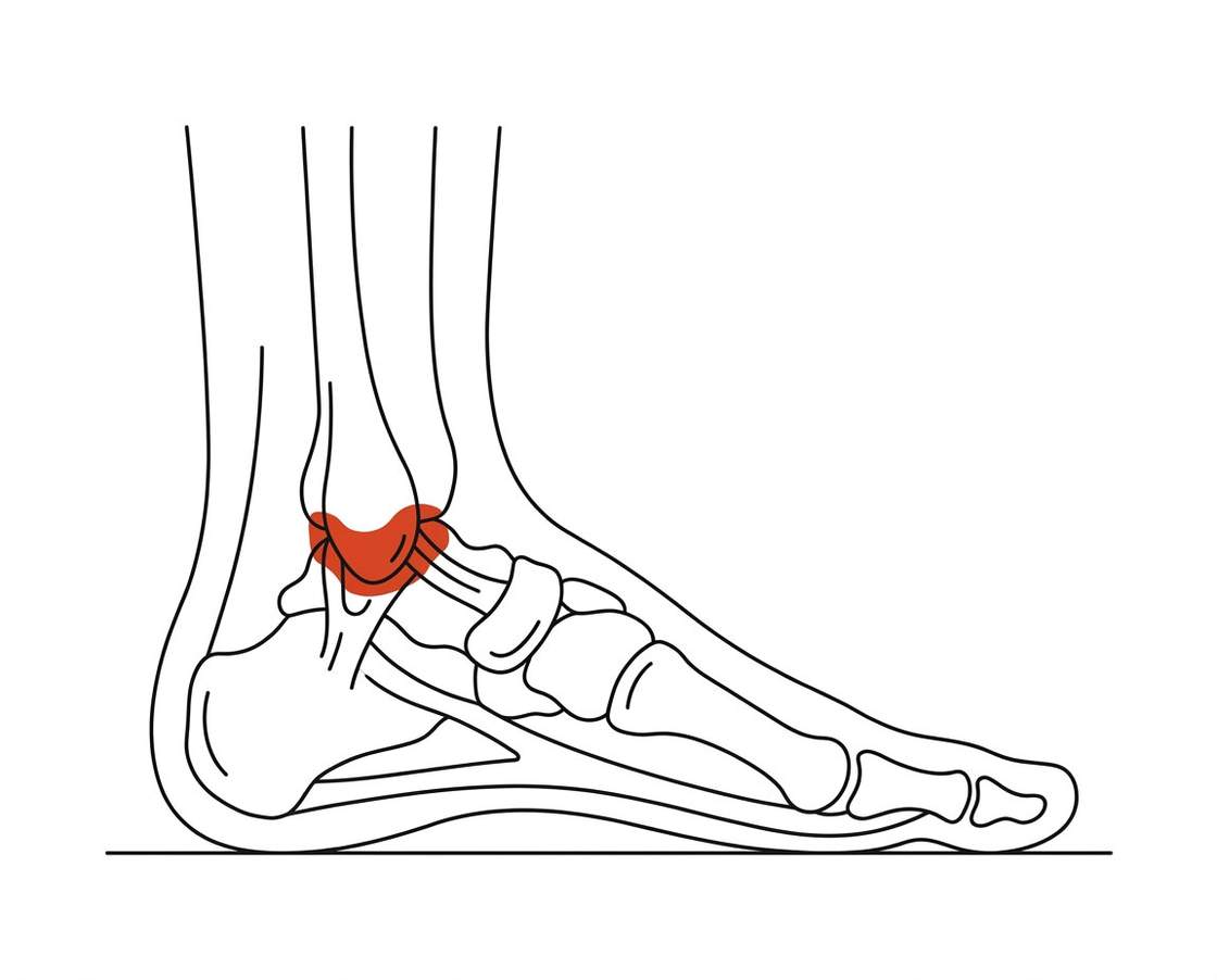 Foot anatomy illustration with the area affected by ankle osteoarthritis highlighted