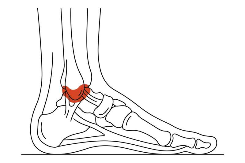 Foot anatomy illustration with the area affected by ankle osteoarthritis highlighted