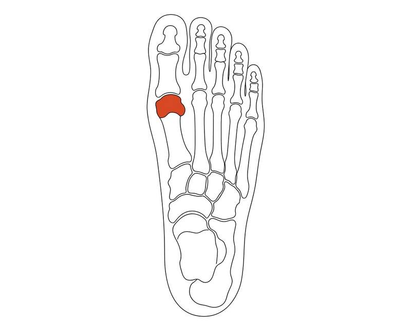 Foot anatomy illustration with the area affected by hallux rigidus highlighted
