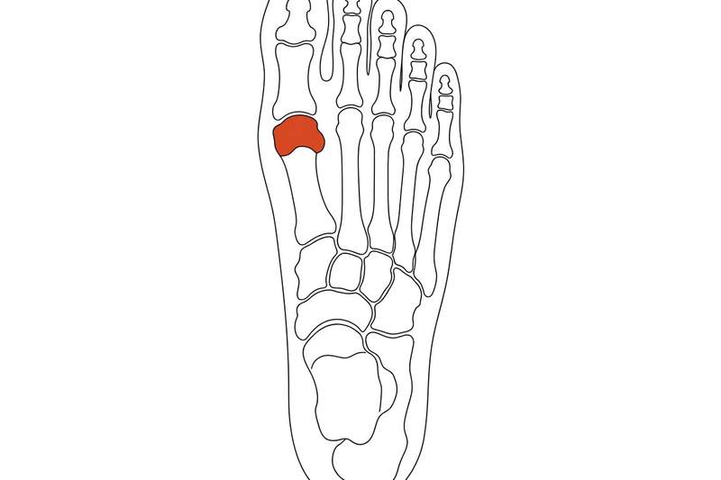 Foot anatomy illustration with the area affected by hallux rigidus highlighted