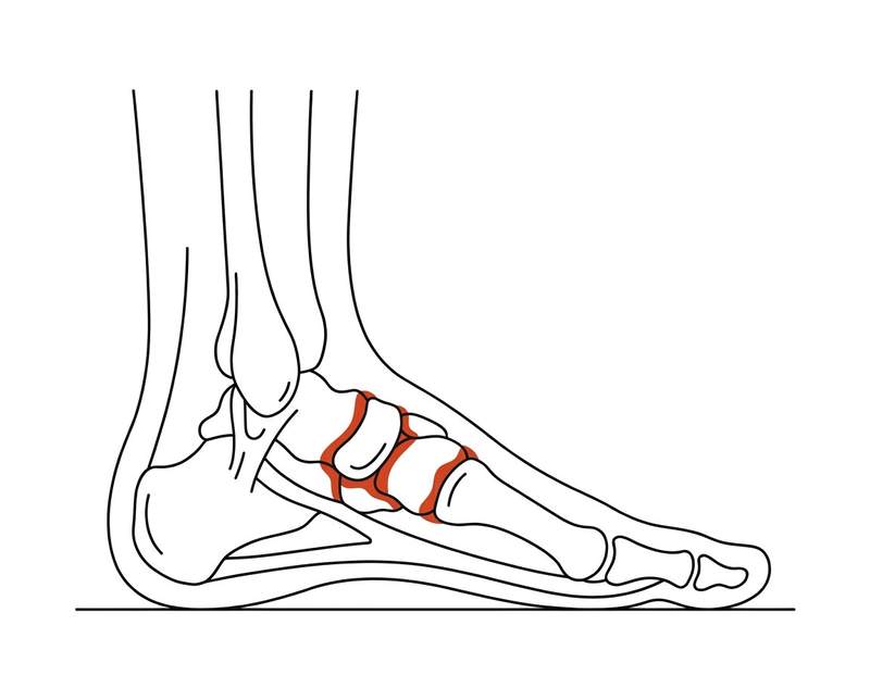 Foot anatomy illustration with the area affected by midfoot arthritis highlighted