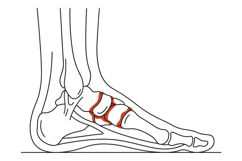Foot anatomy illustration with the area affected by midfoot arthritis highlighted