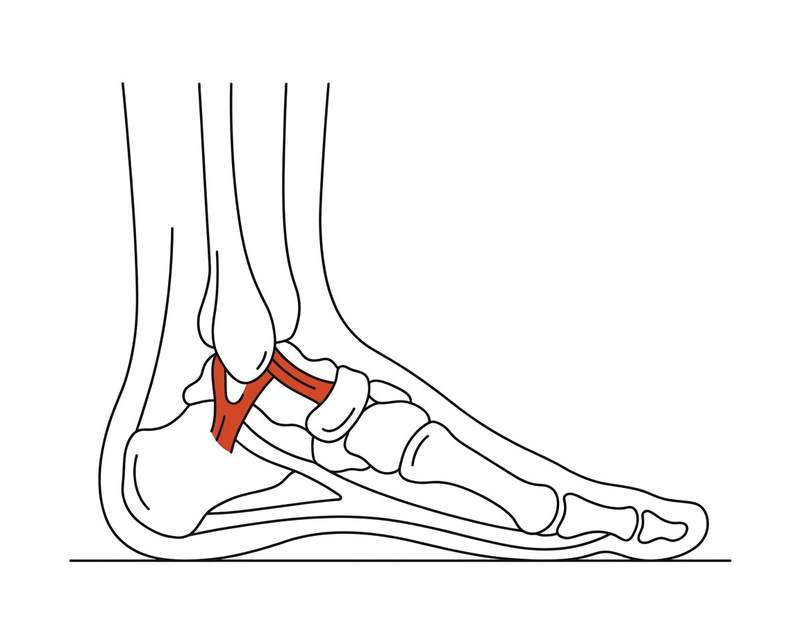 Foot anatomy illustration with the area affected by chronic ankle instability highlighted
