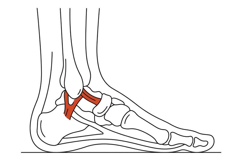 Foot anatomy illustration with the area affected by chronic ankle instability highlighted