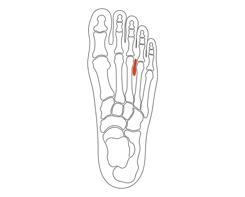 Foot anatomy illustration with the area affected by morton's neuroma highlighted
