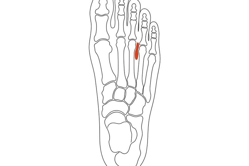 Foot anatomy illustration with the area affected by morton's neuroma highlighted