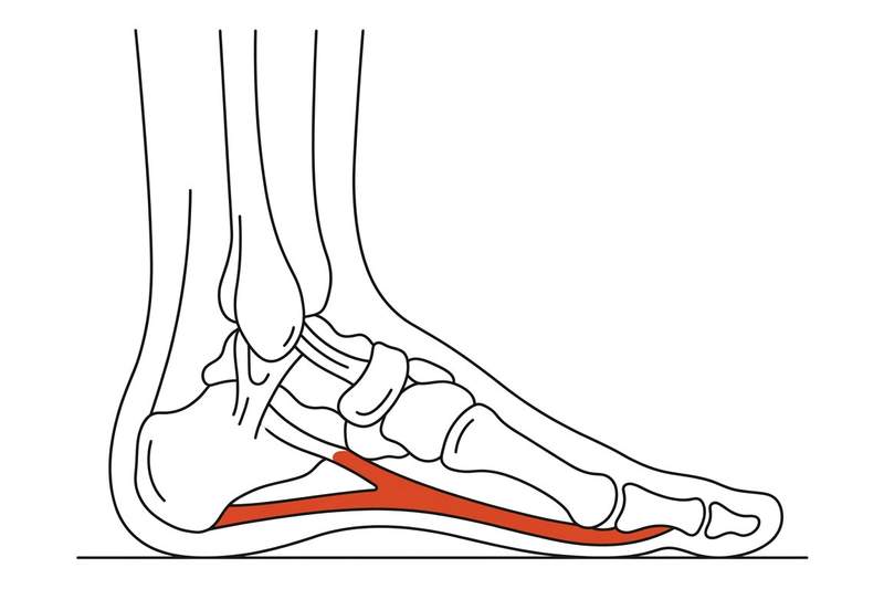 Foot anatomy illustration with the area affected by plantar fasciitis highlighted