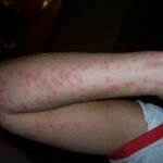 Bed Bug Bites